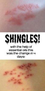 Shingles- help from essential oils