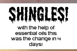 Shingles- help from essential oils