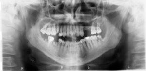 Wisdom Teeth Removal and Recovery- x-rays