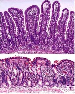 Villi help absorption but with celiac disease they become blunted and can't do their job.