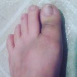 Bruised foot and toes- Happy New Year