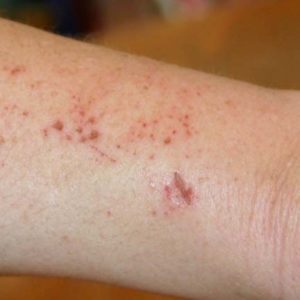 Shingles, I used essential oils to help me heal