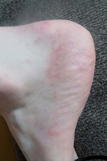 Serum Sickness rash from a wasp sting