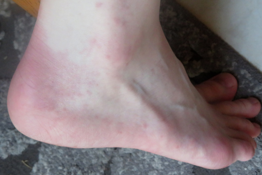 Serum Sickness rash caused by a wasp sting